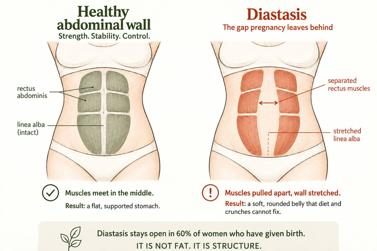Diagram: healthy abdominal wall vs diastasis